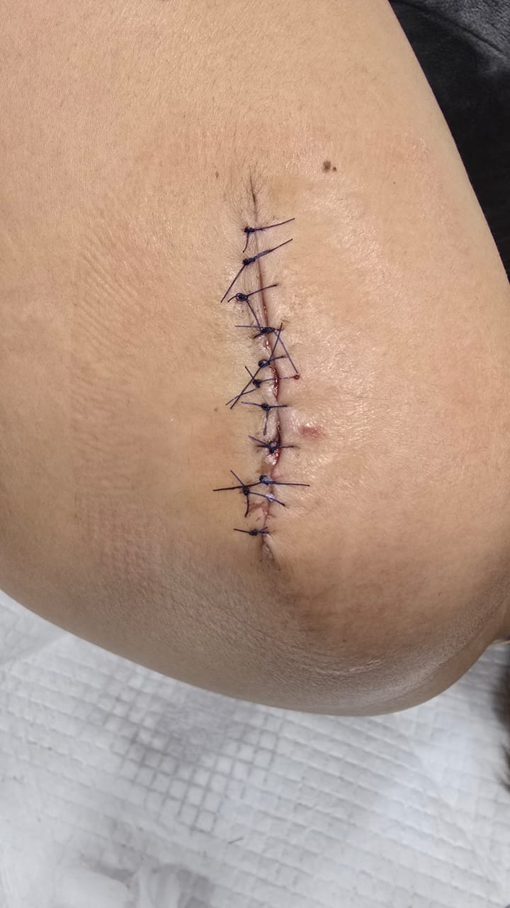 Bowen disease post-surgery sutures